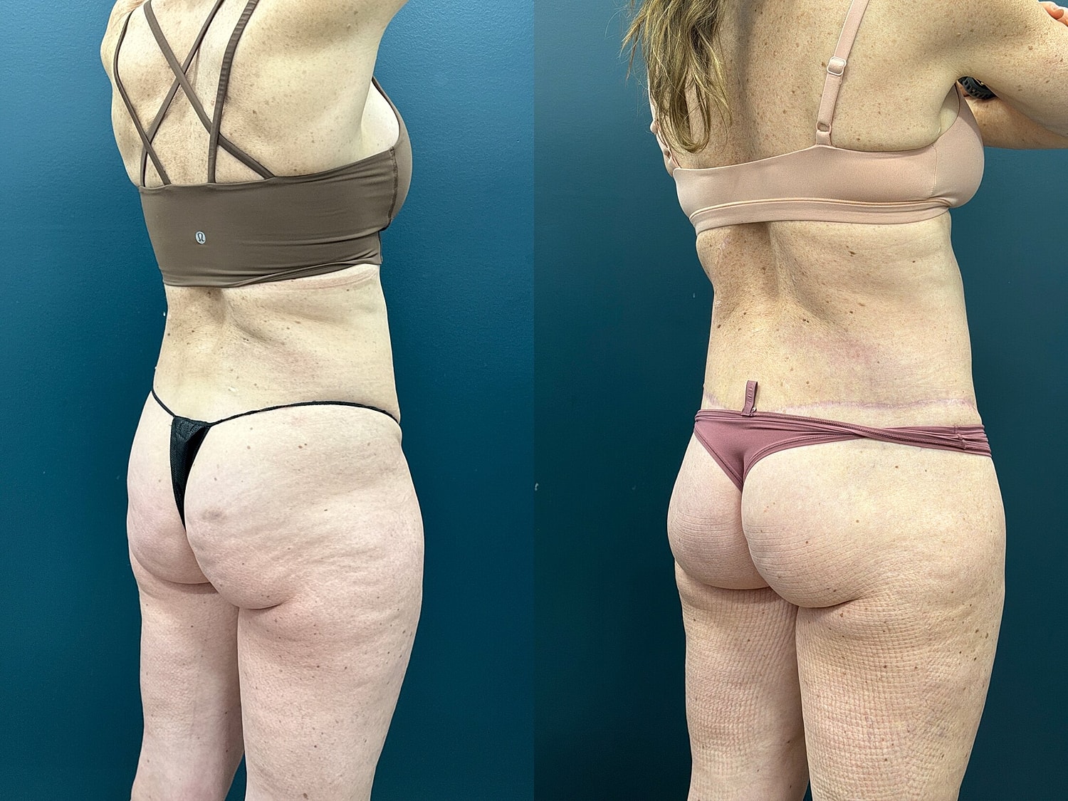 Lower Body Lift Before & After