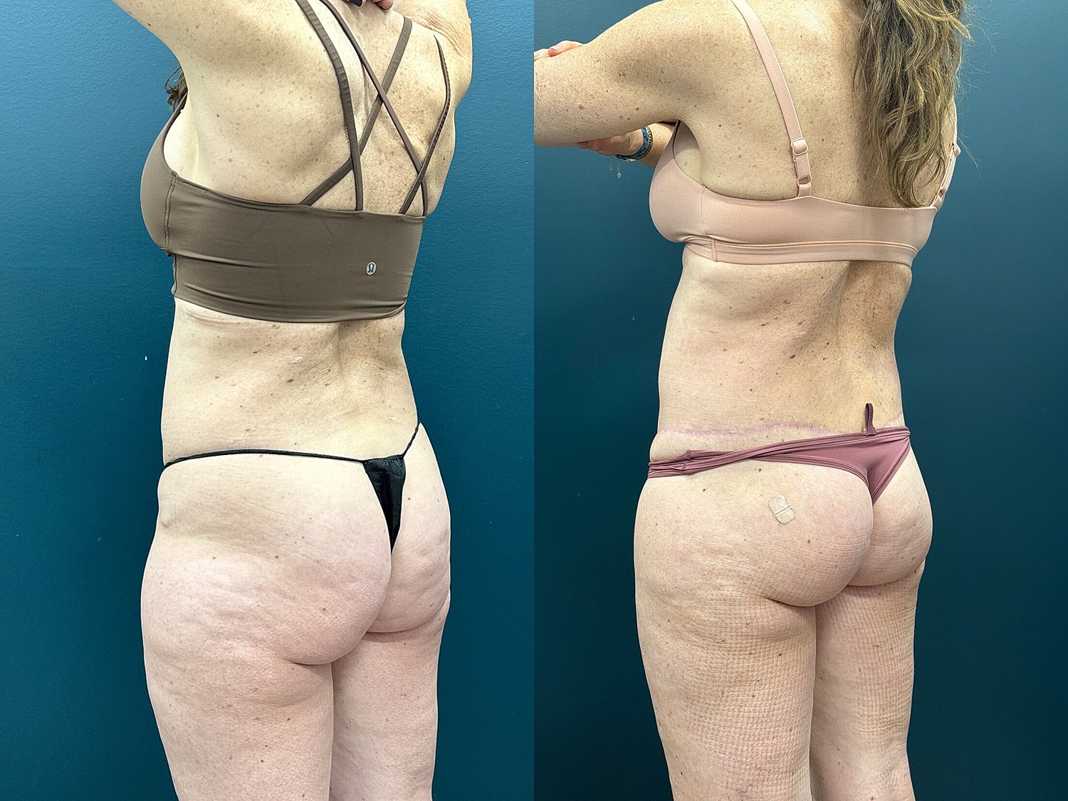 Lower Body Lift Before & After