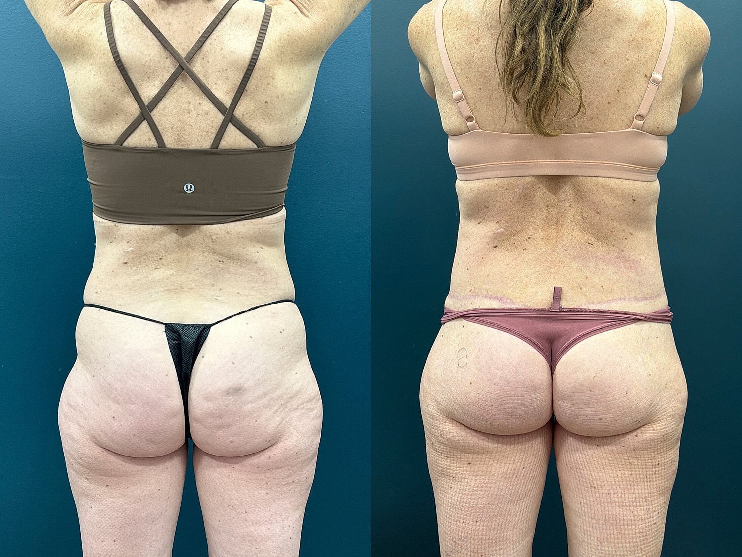 Lower Body Lift Before & After