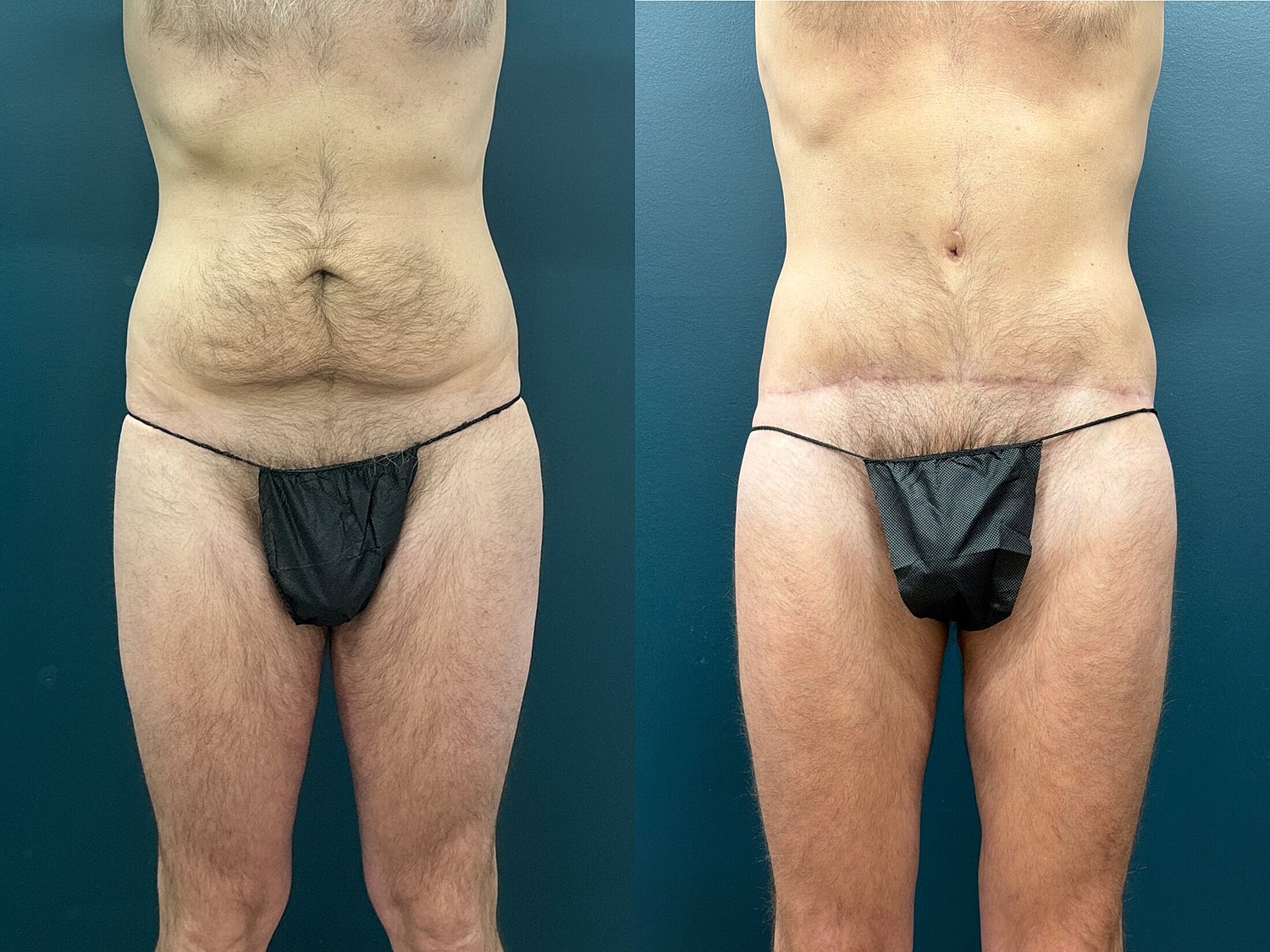Lower Body Lift Before & After