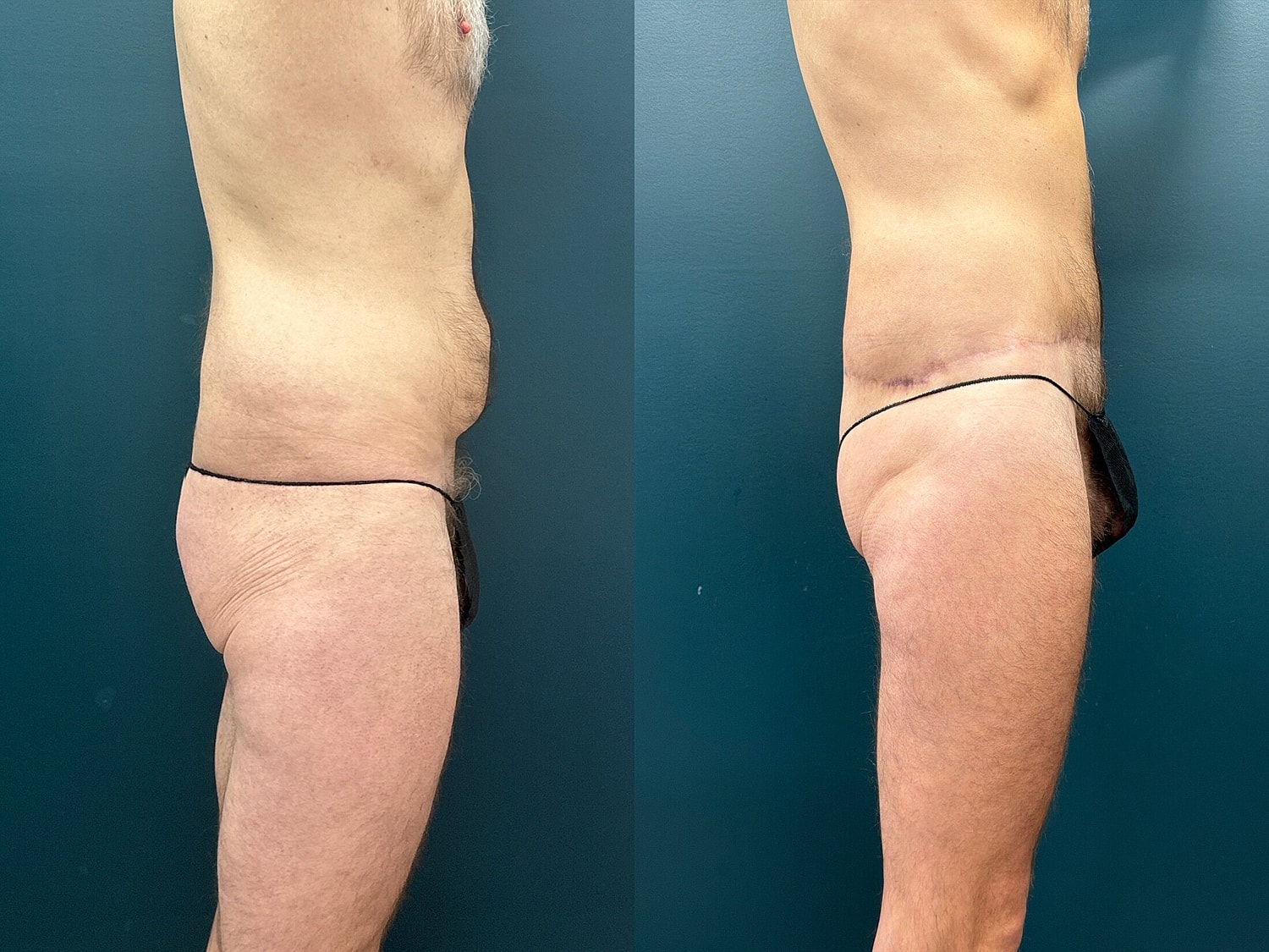 Lower Body Lift Before & After