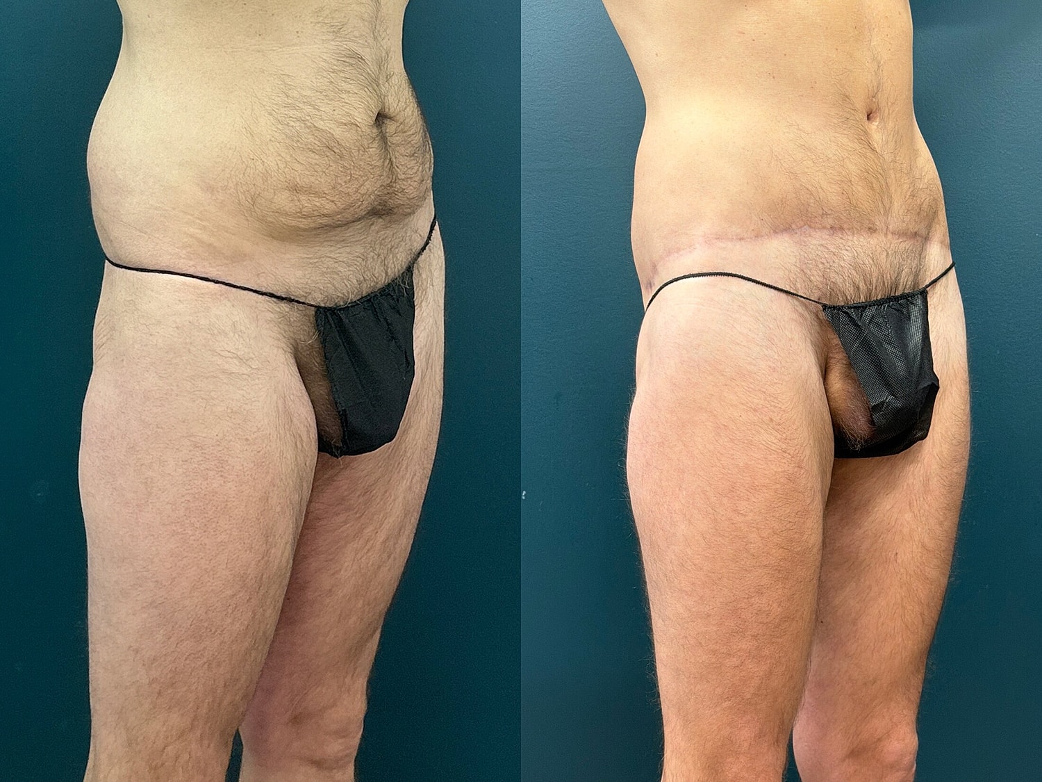 Lower Body Lift Before & After