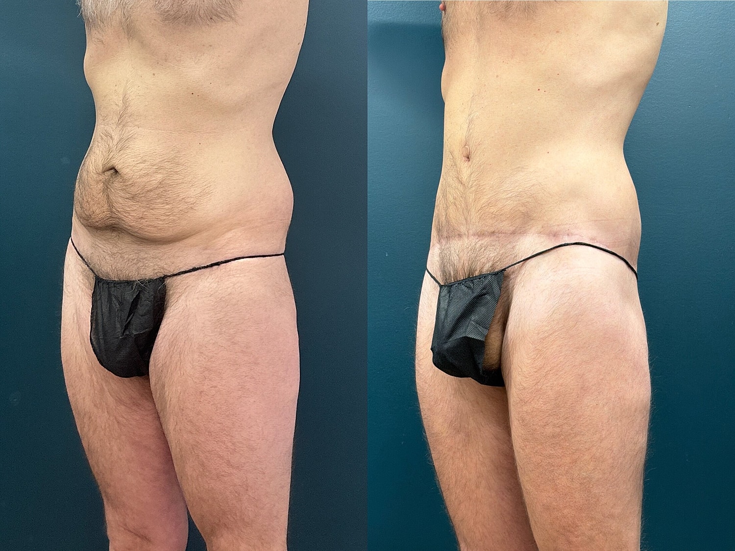 Lower Body Lift Before & After