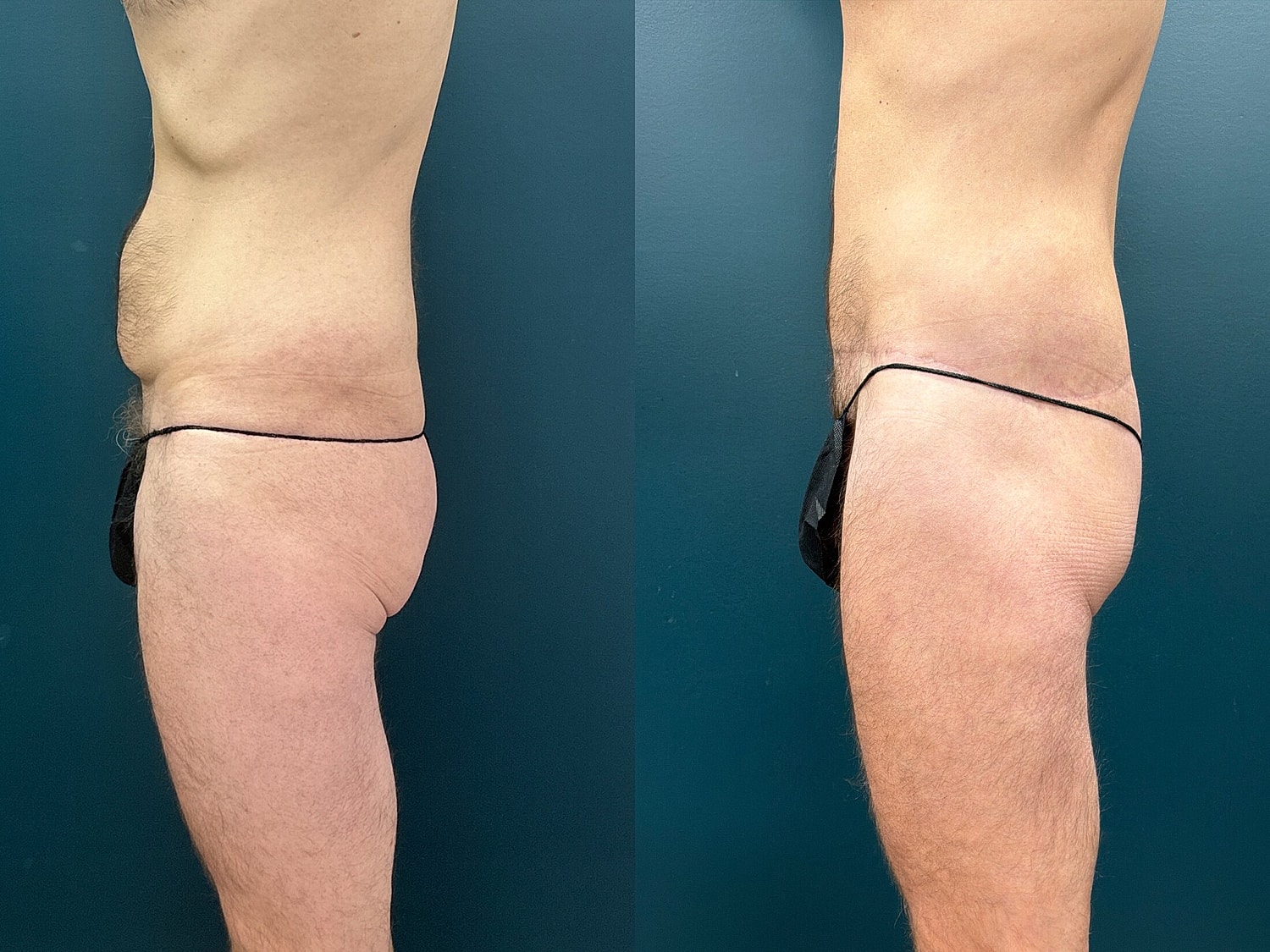 Lower Body Lift Before & After