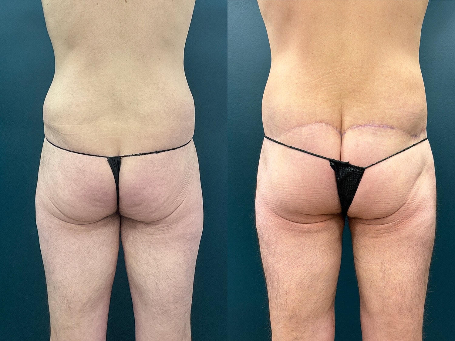 Lower Body Lift Before & After