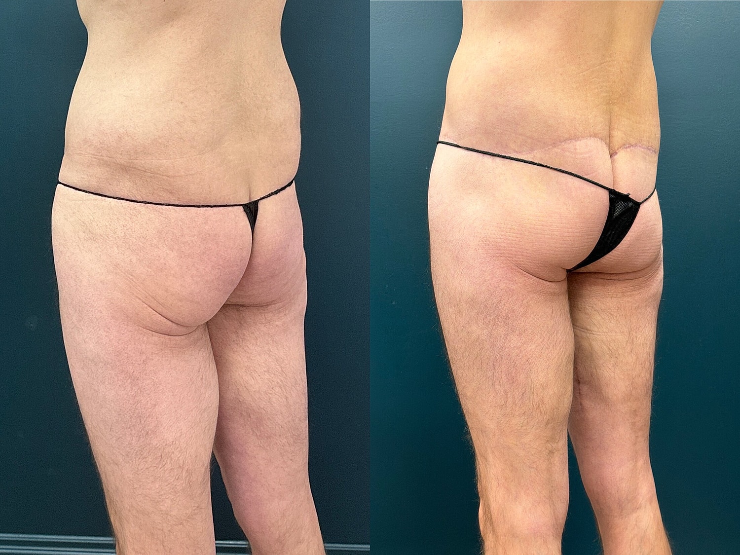 Lower Body Lift Before & After