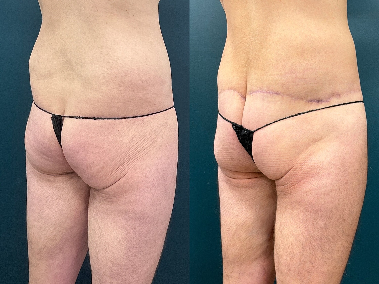 Lower Body Lift Before & After