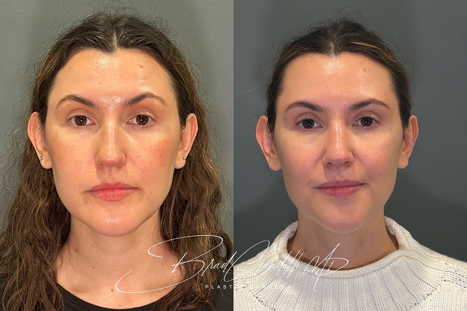 Rhinoplasty Before & After