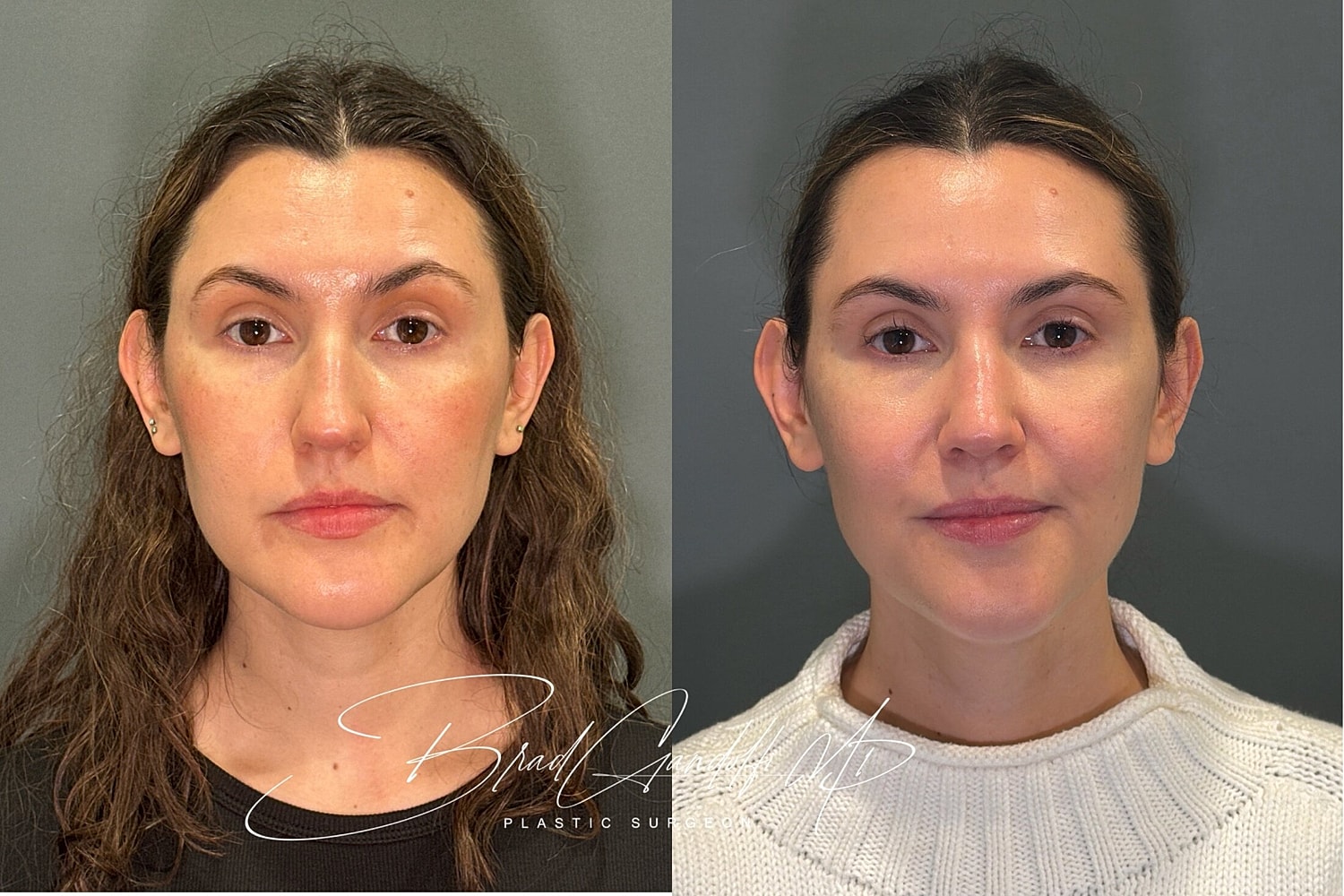 Rhinoplasty Before & After