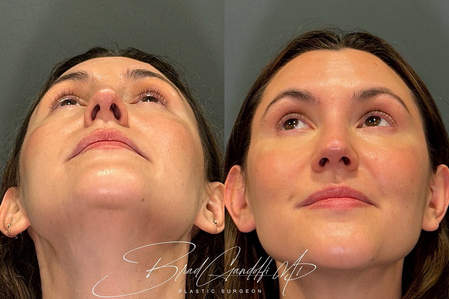 Rhinoplasty Before & After