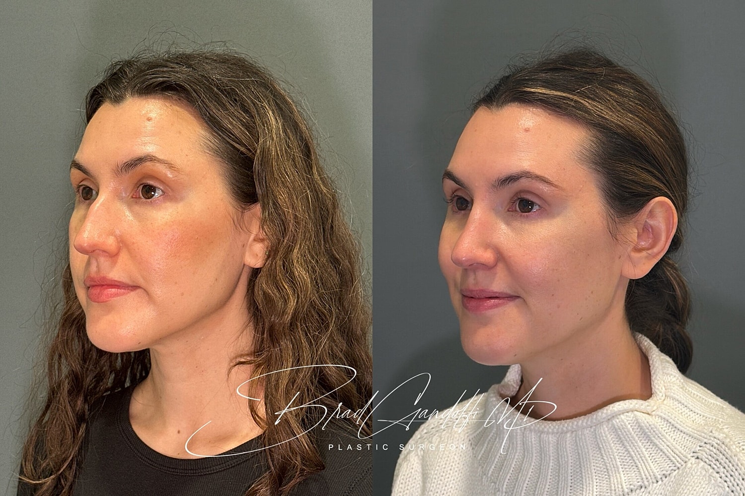 Rhinoplasty Before & After
