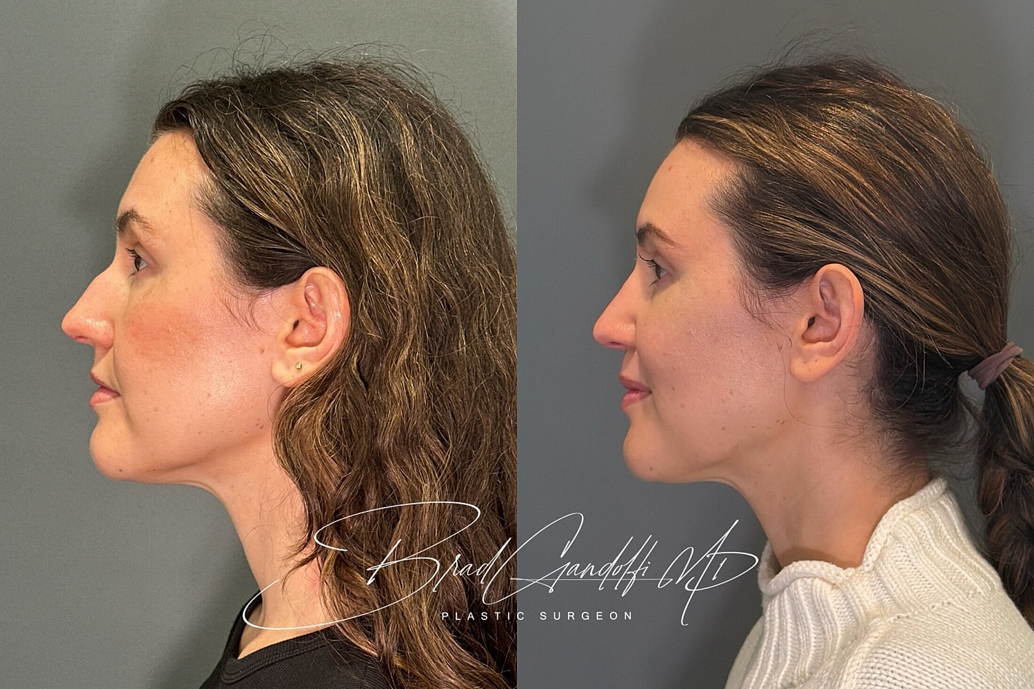 Rhinoplasty Before & After