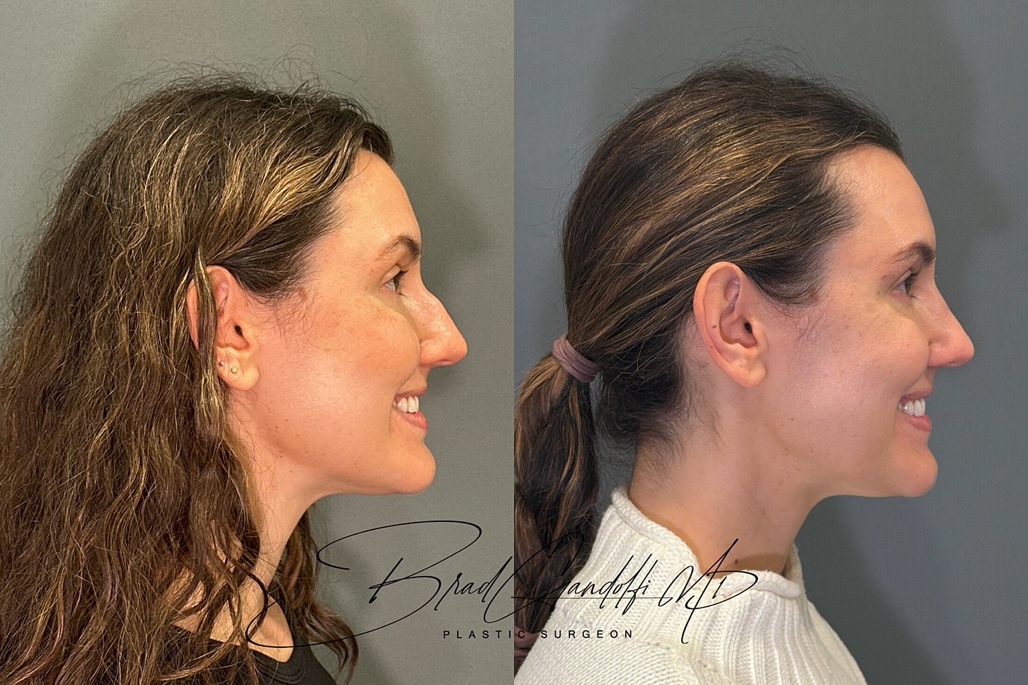 Rhinoplasty Before & After