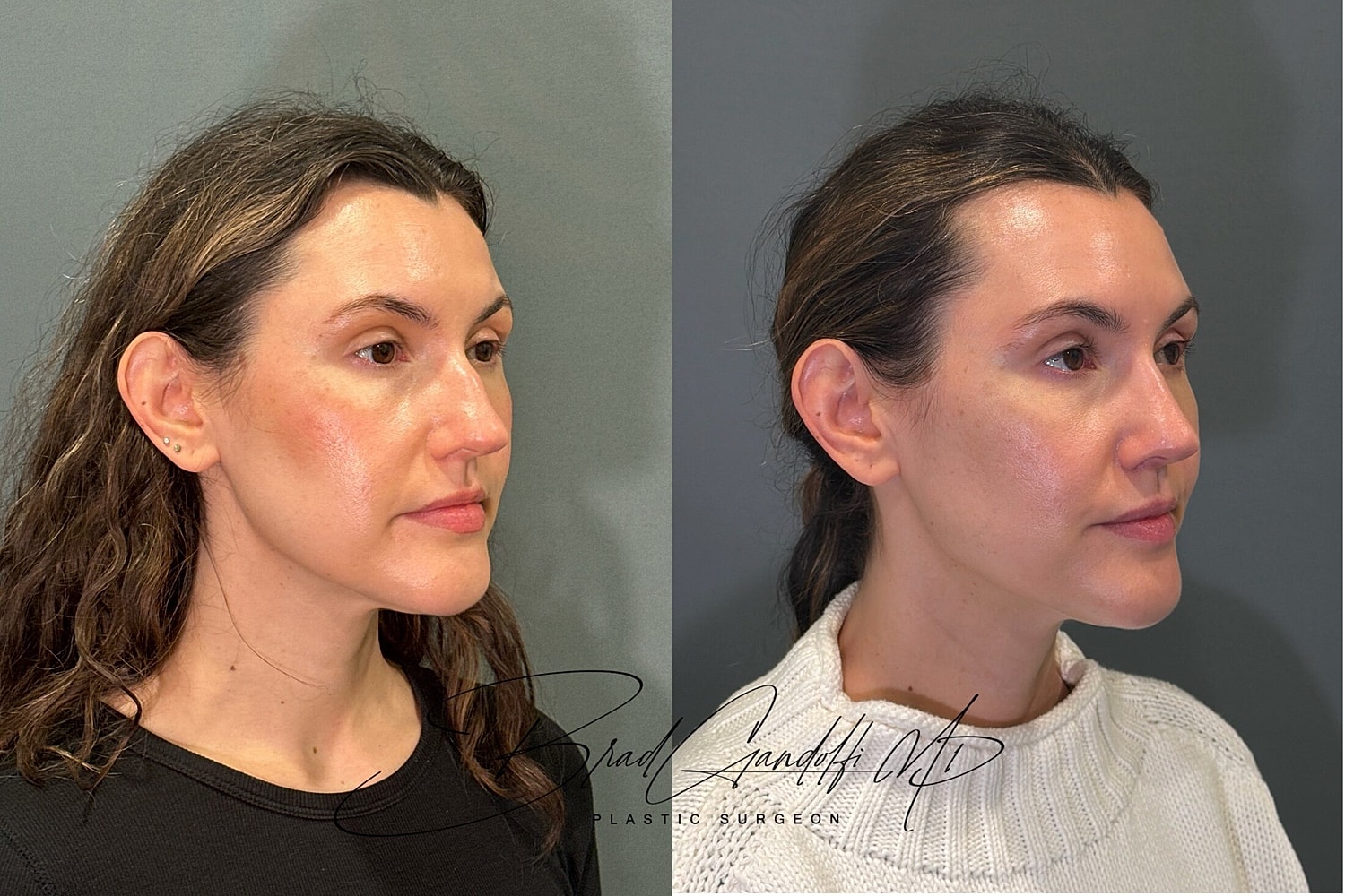 Rhinoplasty Before & After
