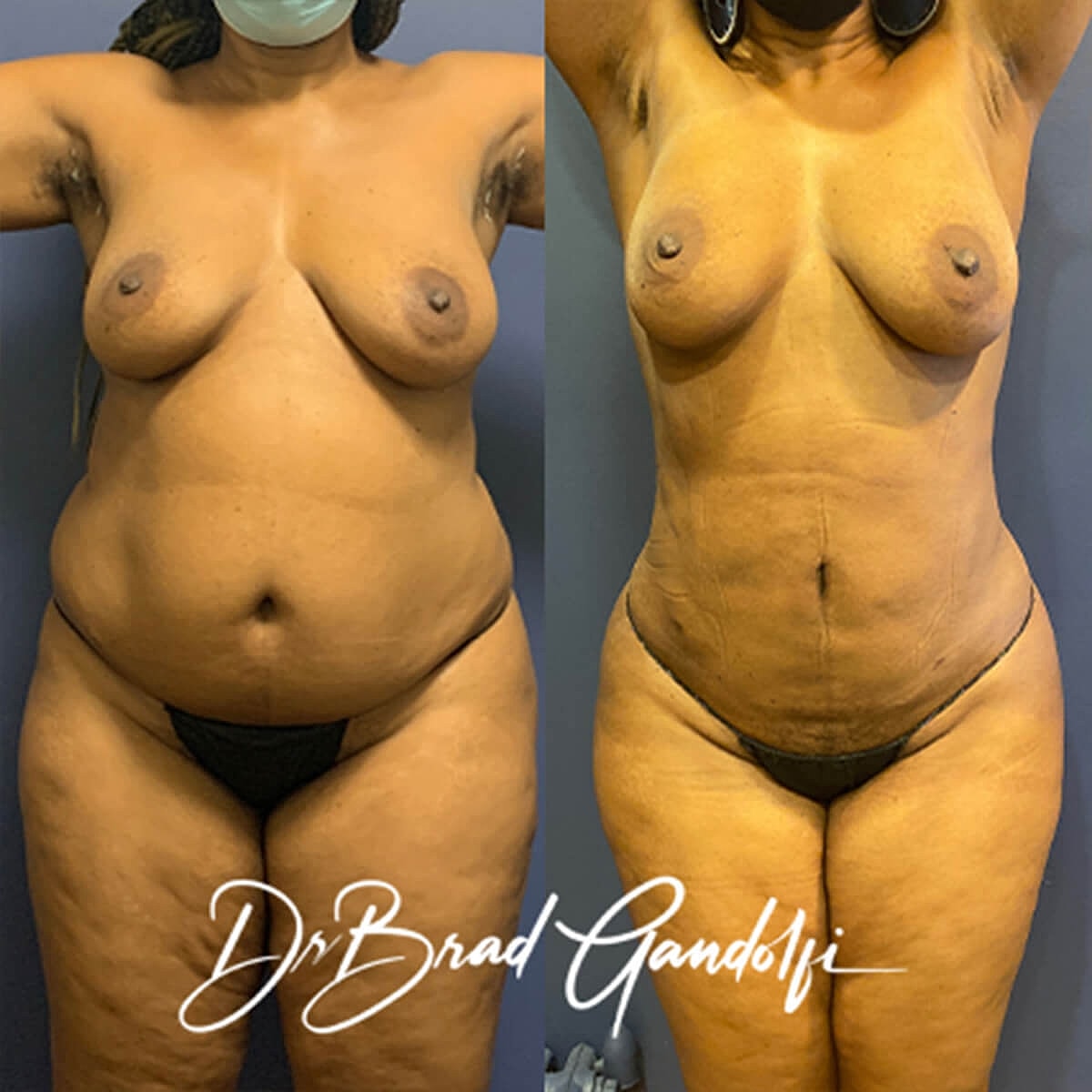 Liposuction Before & After
