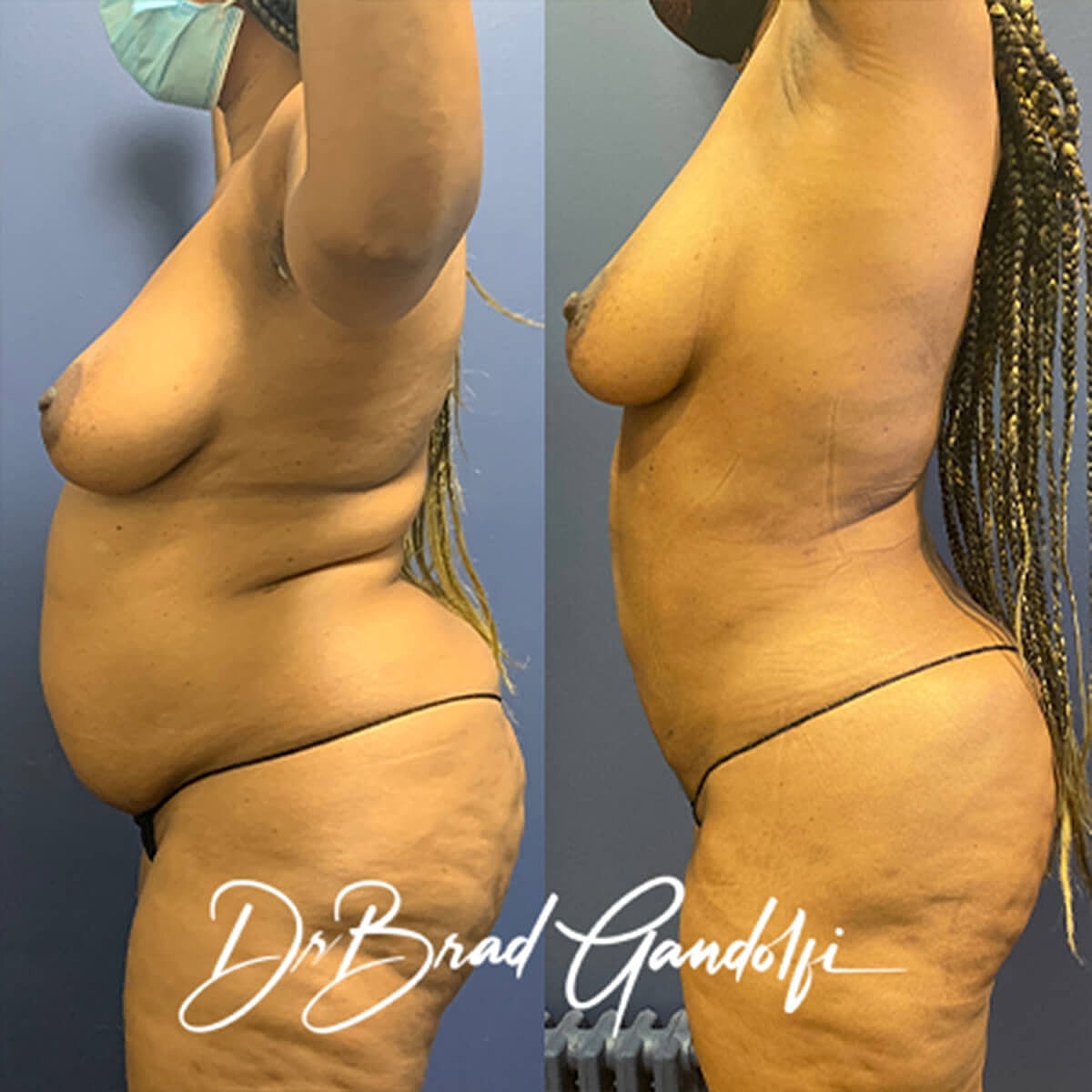 Liposuction Before & After