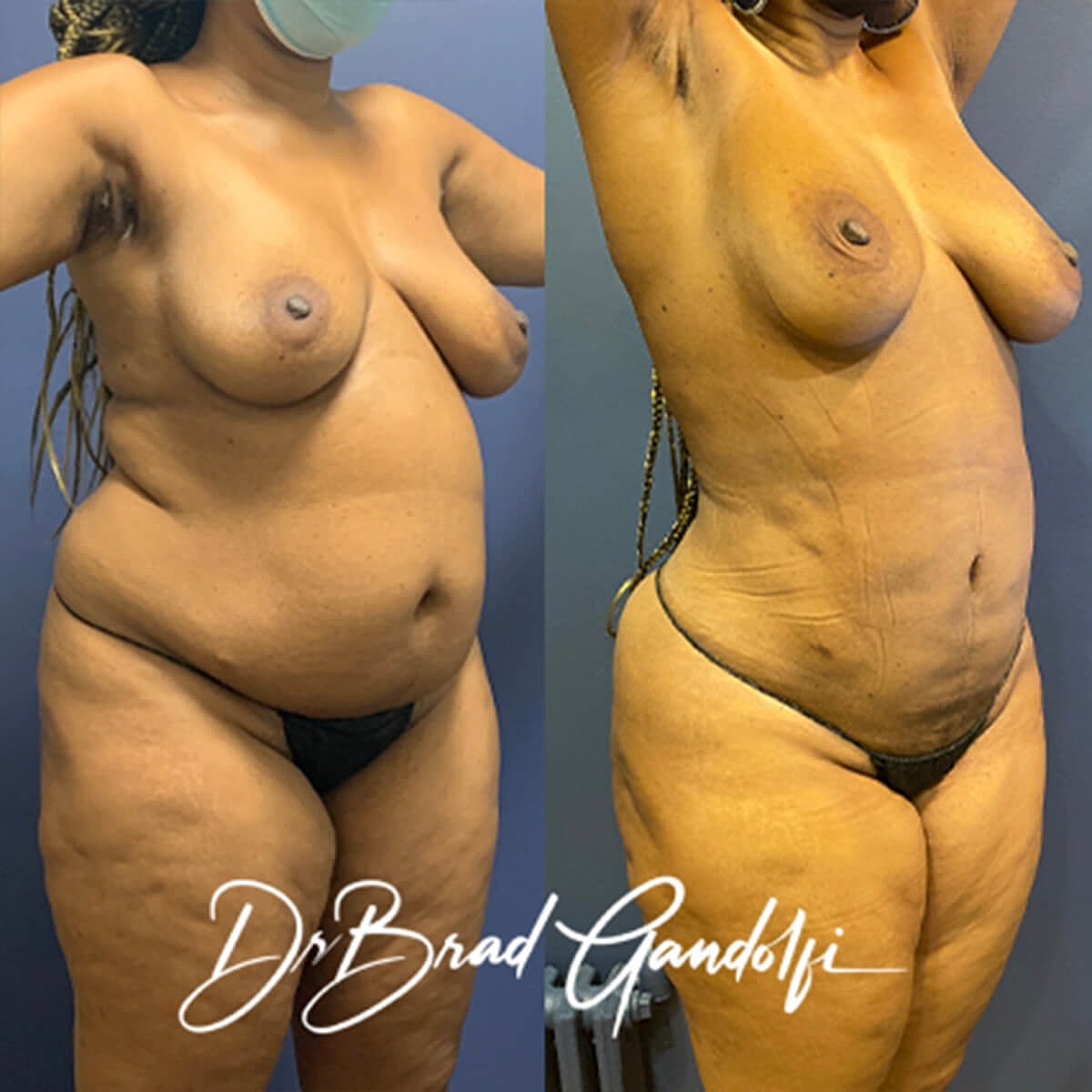 Liposuction Before & After