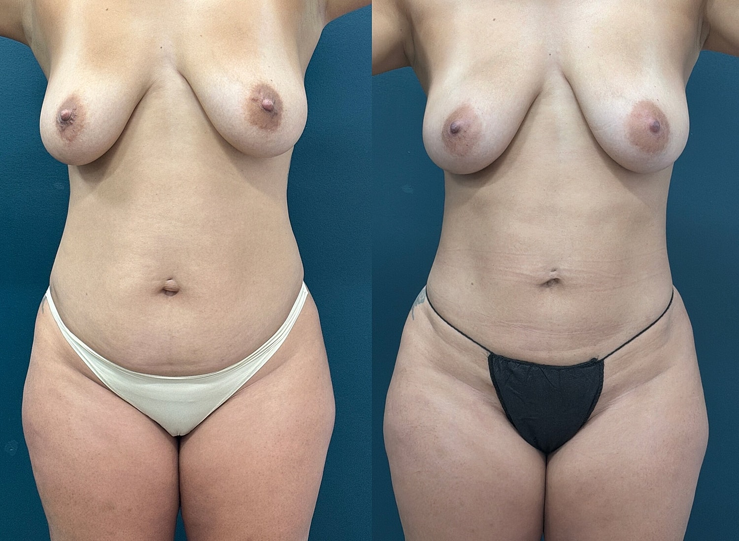 Liposuction Before & After