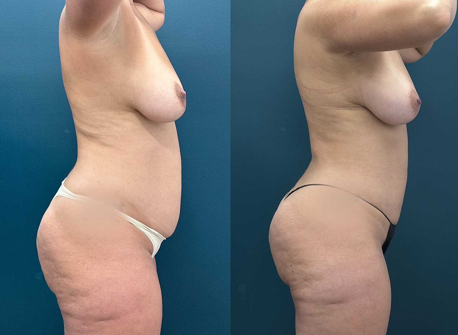 Liposuction Before & After
