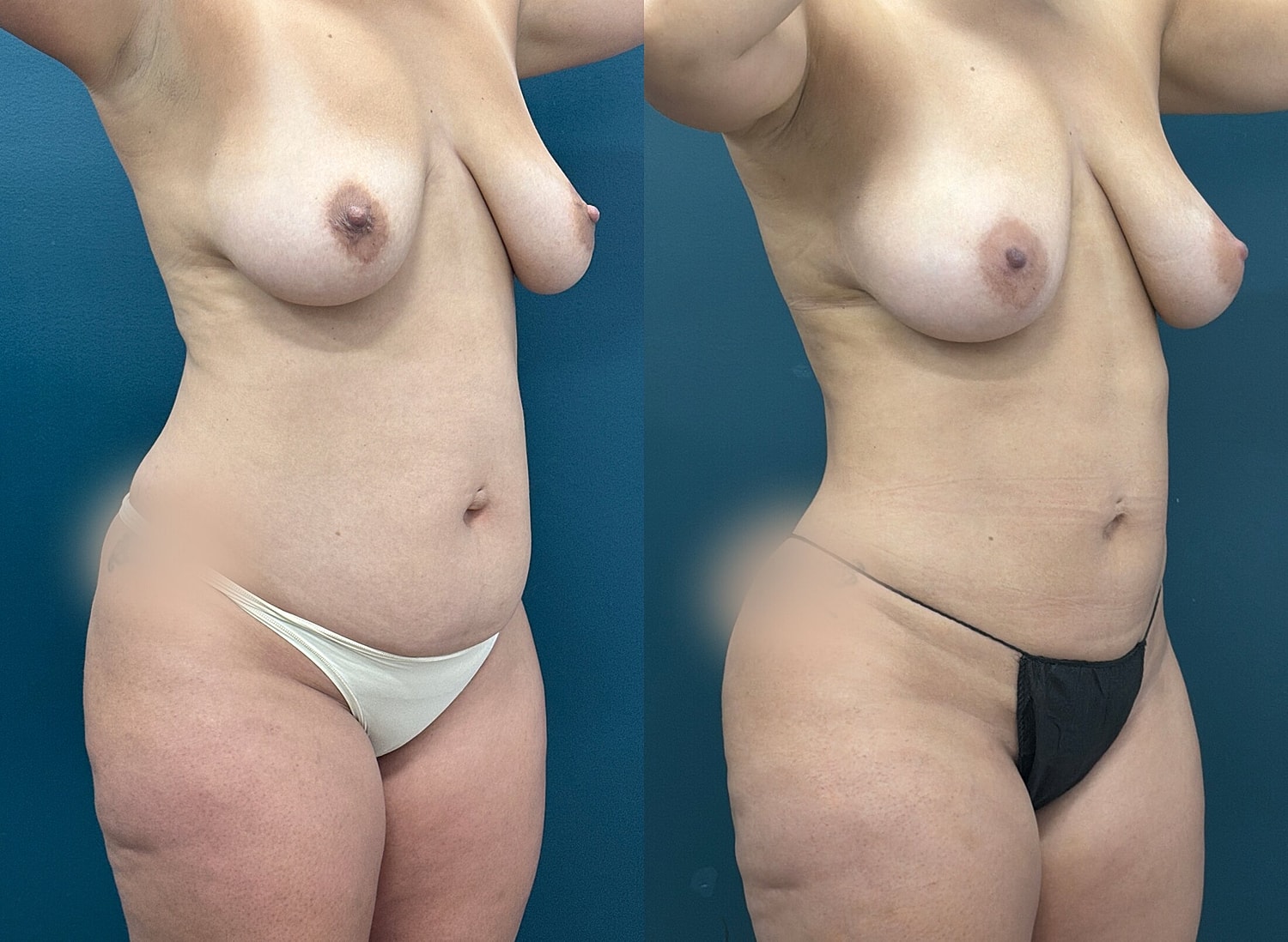 Liposuction Before & After
