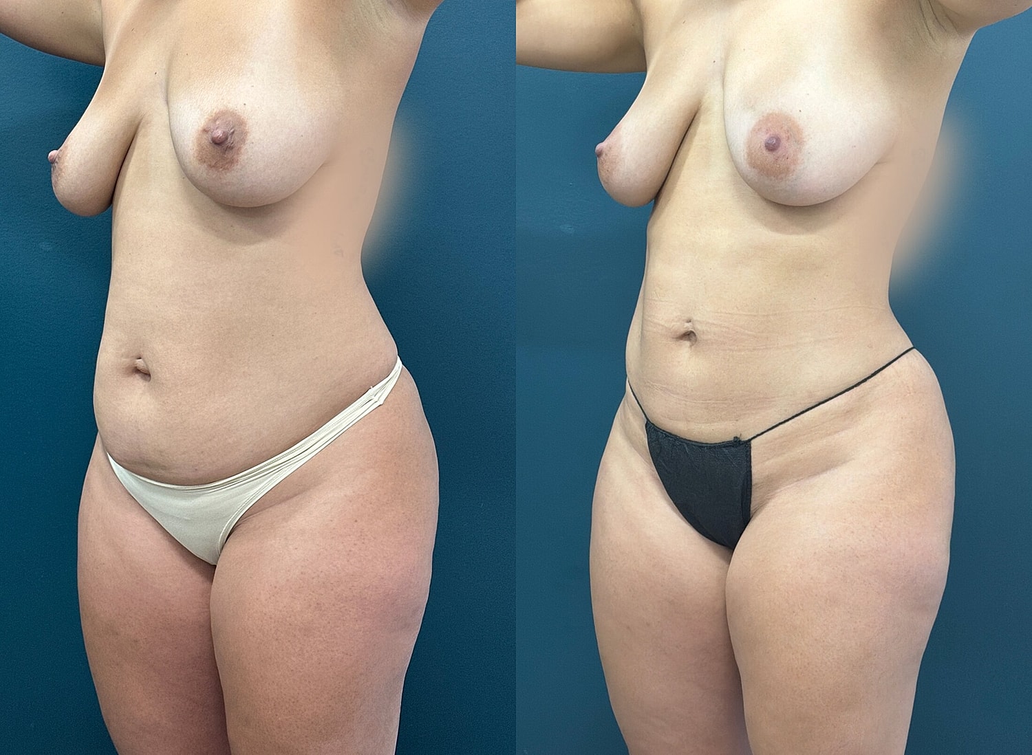 Liposuction Before & After