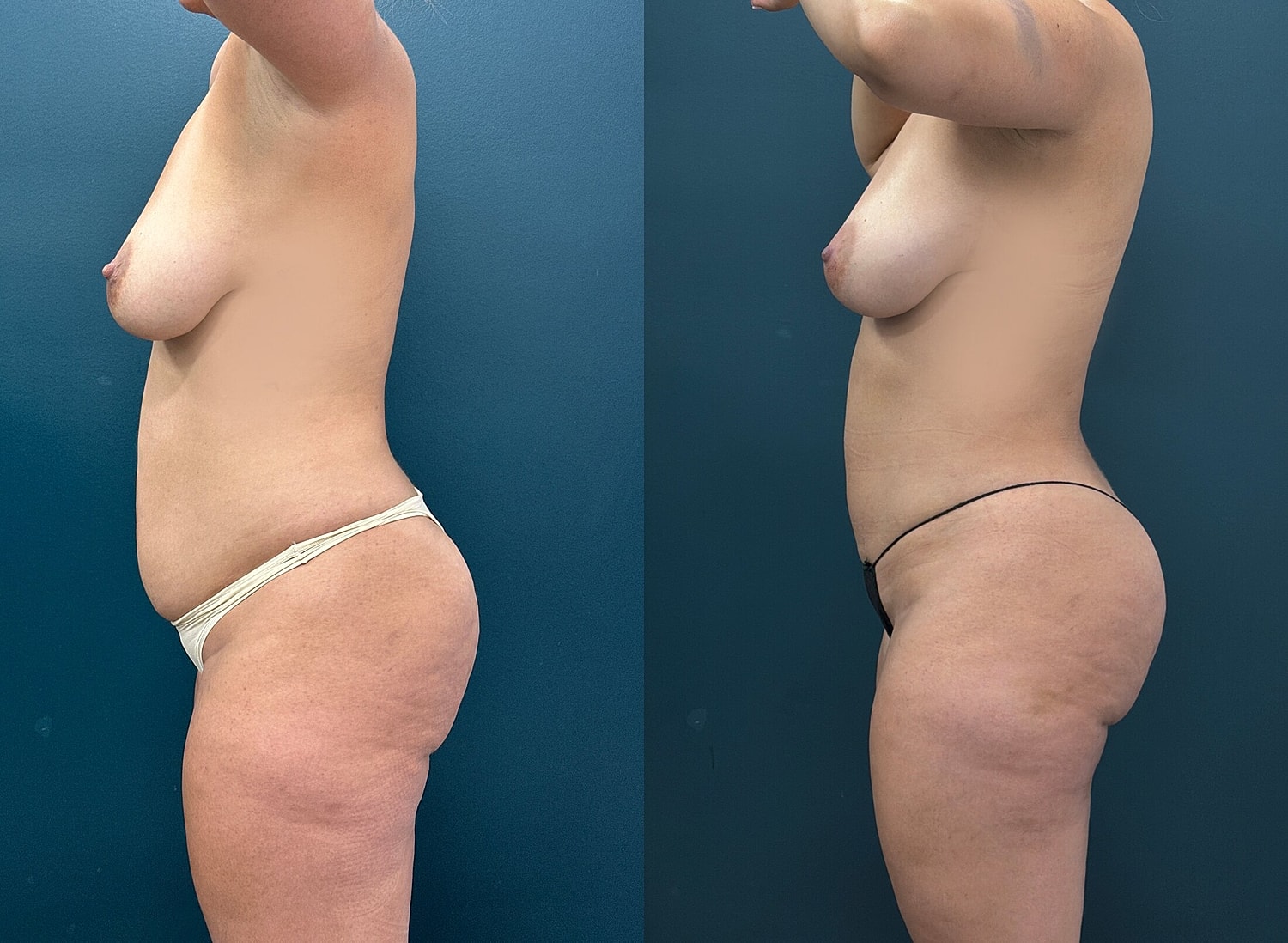 Liposuction Before & After