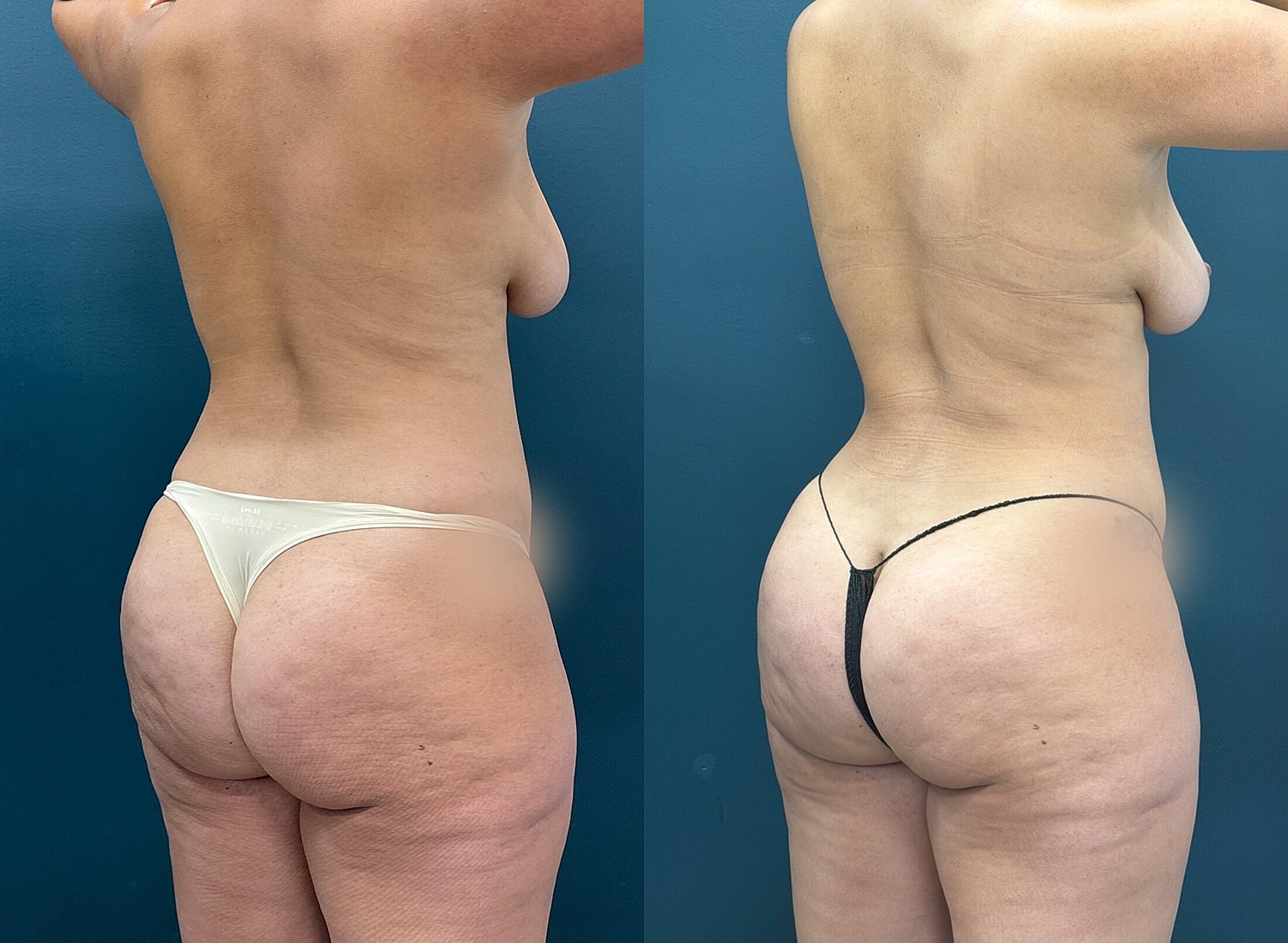 Liposuction Before & After