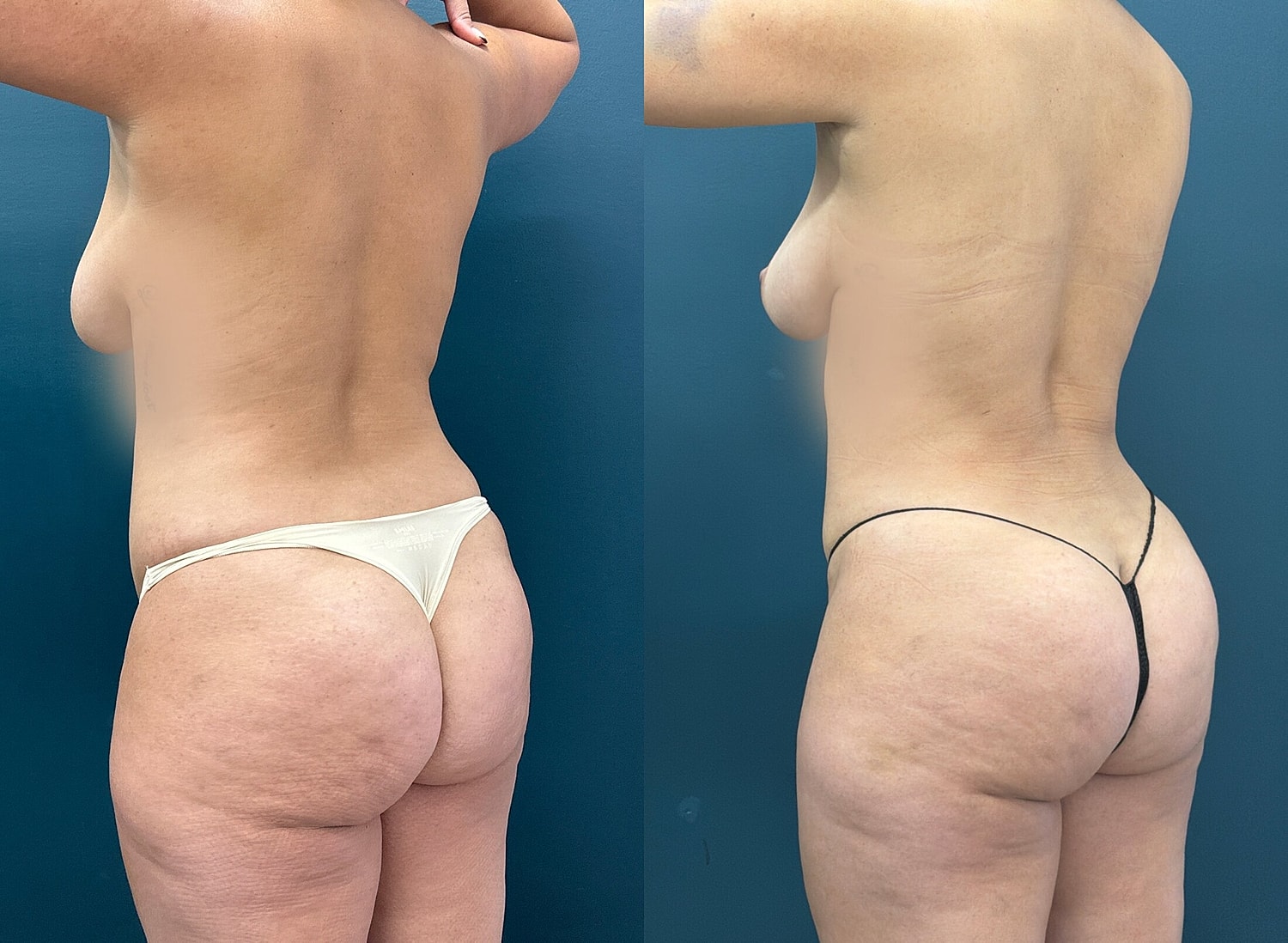 Liposuction Before & After