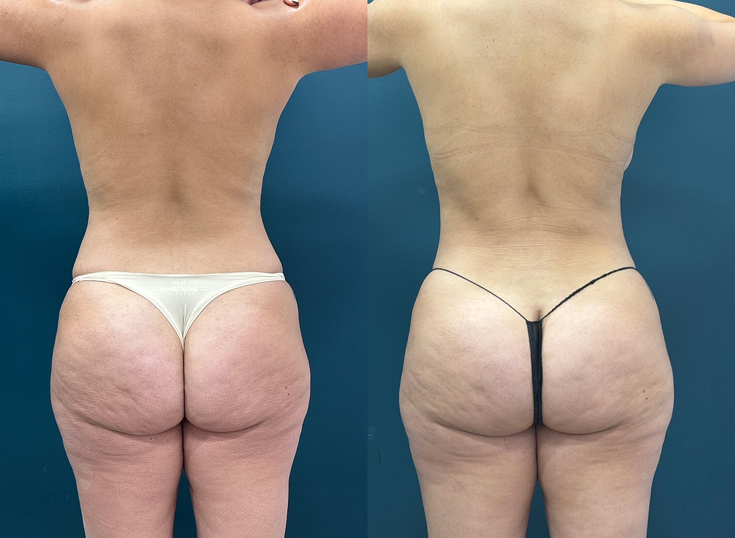 Liposuction Before & After