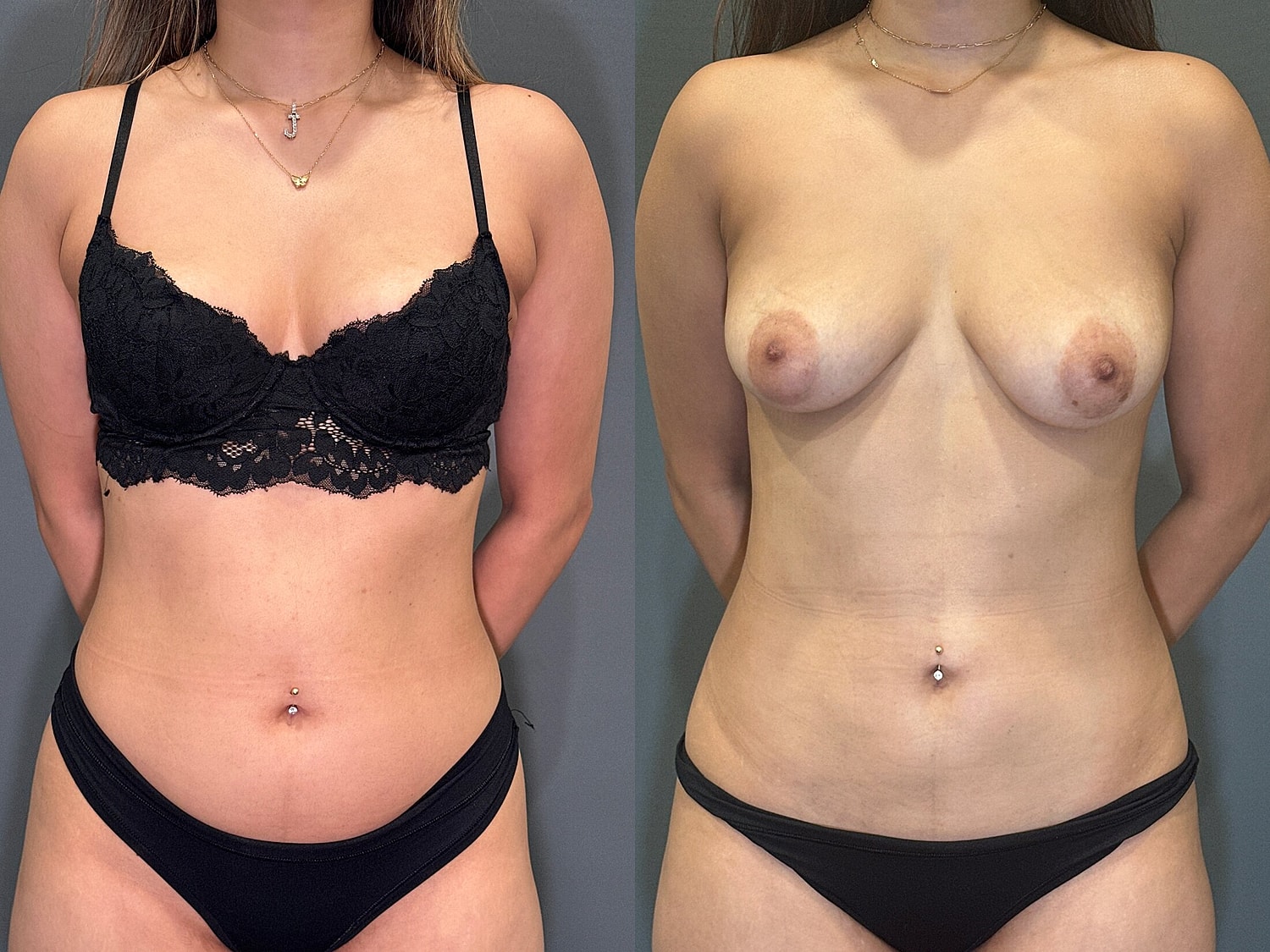 Liposuction Before & After