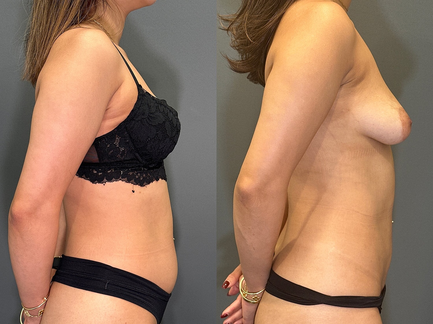 Liposuction Before & After