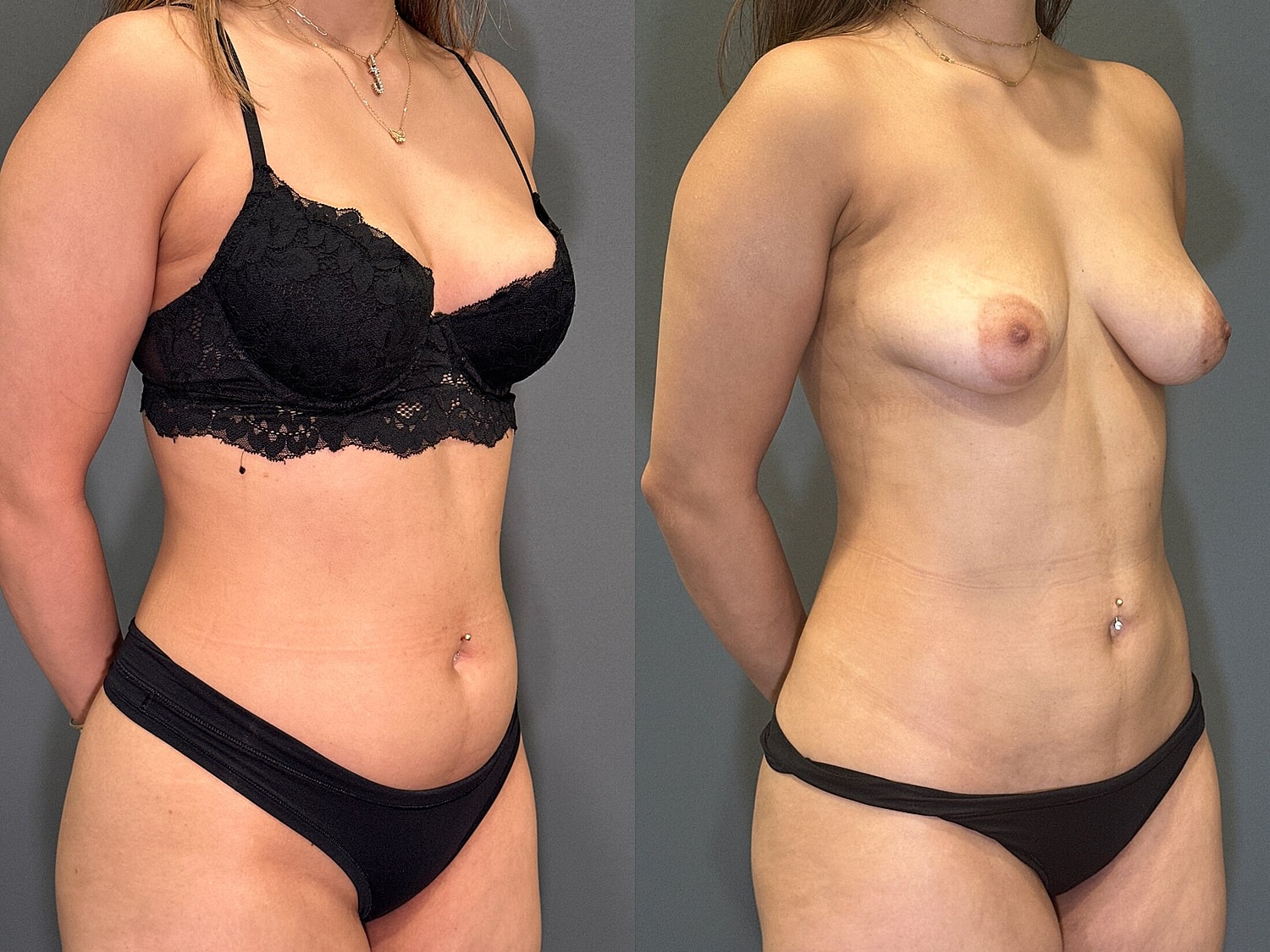 Liposuction Before & After
