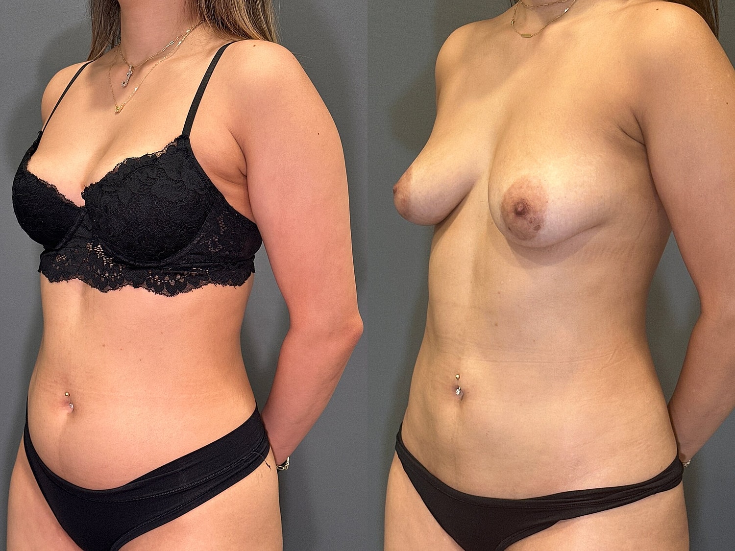 Liposuction Before & After