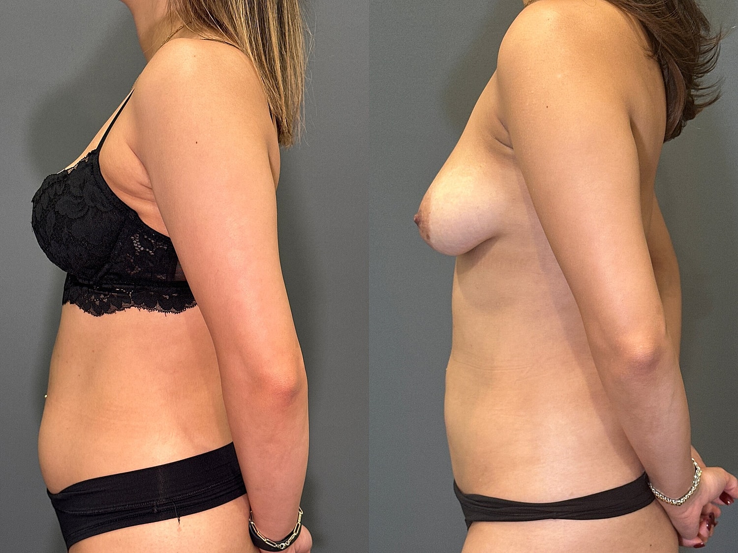 Liposuction Before & After