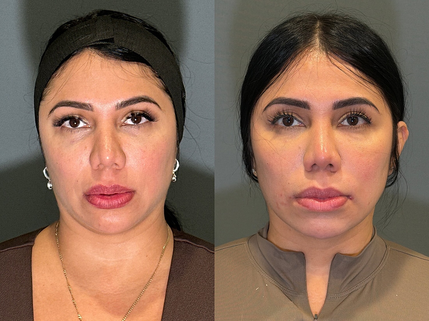 Liposuction Before & After