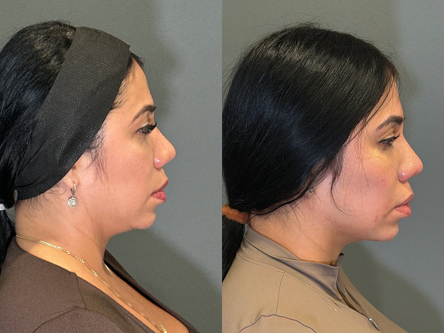 Liposuction Before & After