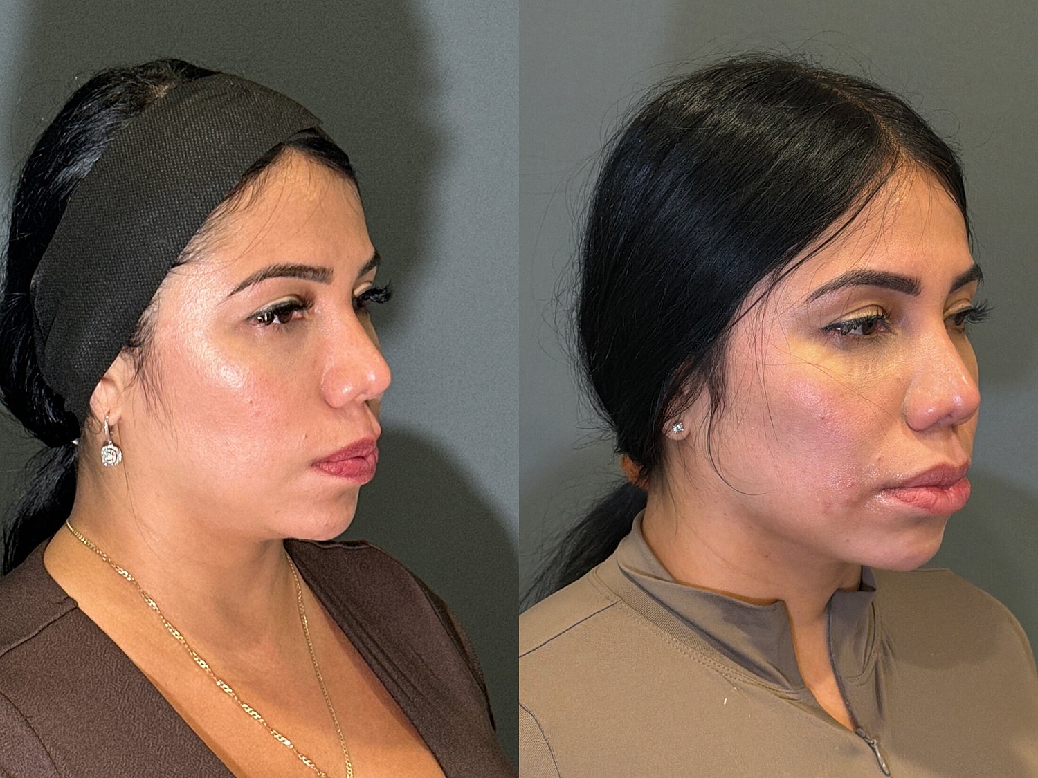Liposuction Before & After