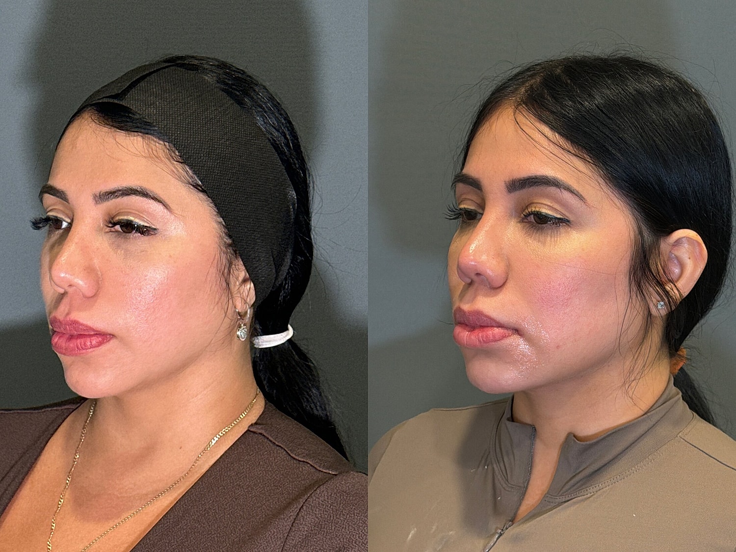 Liposuction Before & After