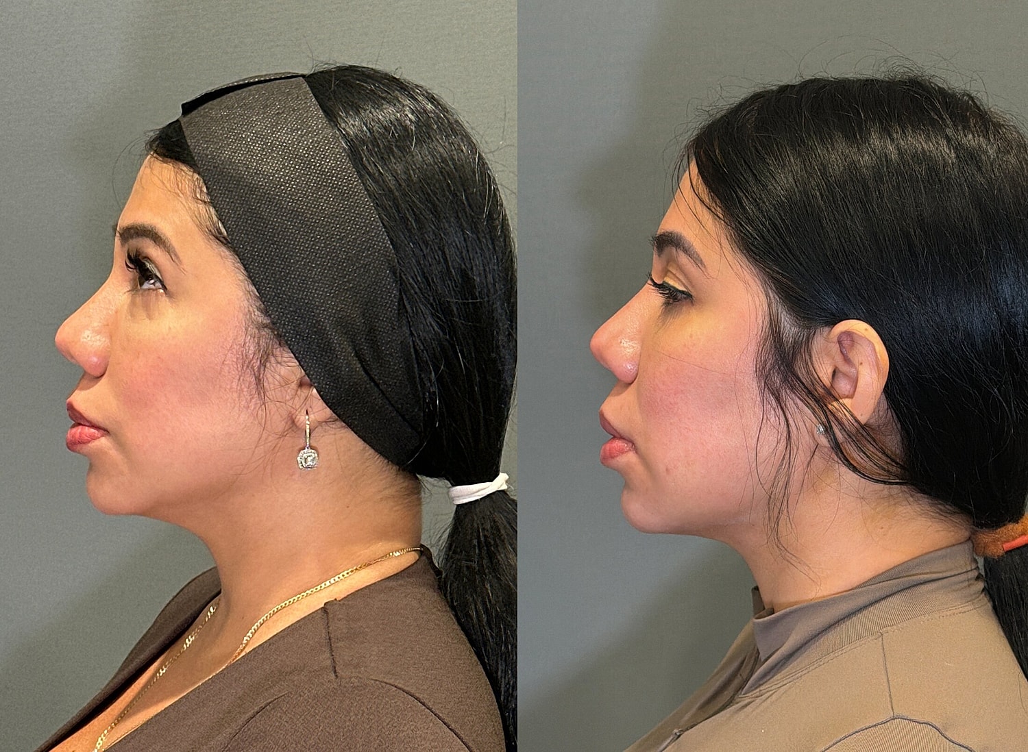 Liposuction Before & After