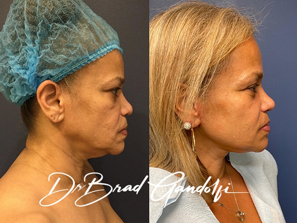 Facelift Before & After