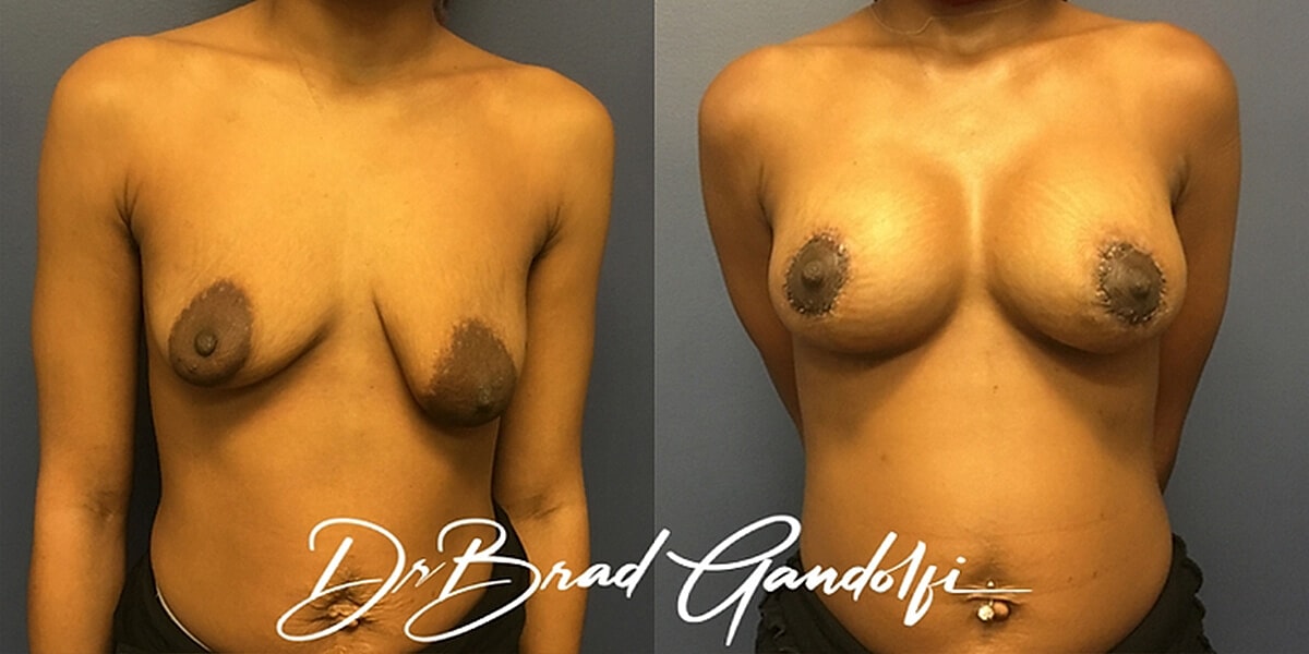 Breast Augmentation Before & After