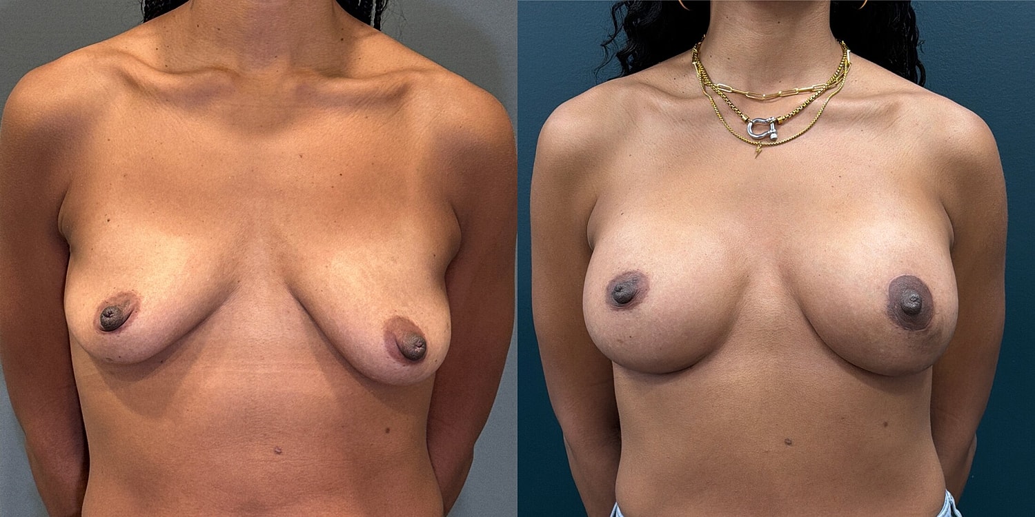 Breast Augmentation Before & After