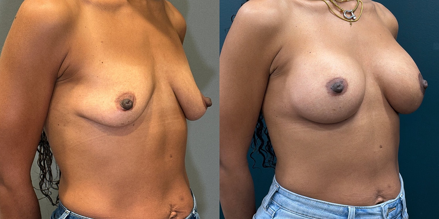 Breast Augmentation Before & After