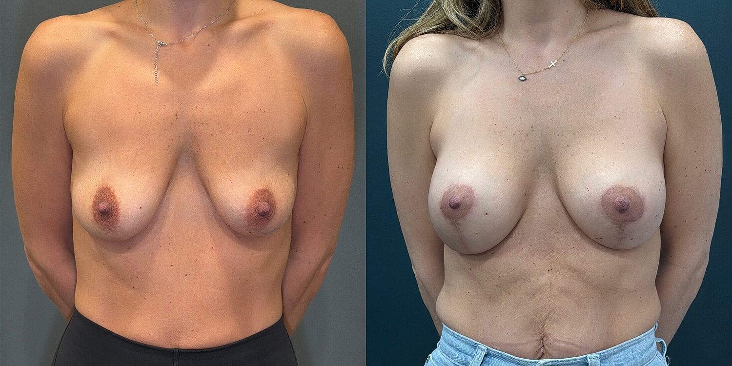 Breast Augmentation Before & After