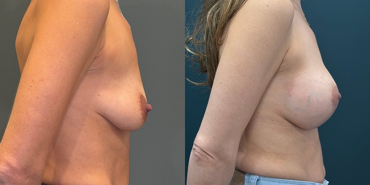 Breast Augmentation Before & After