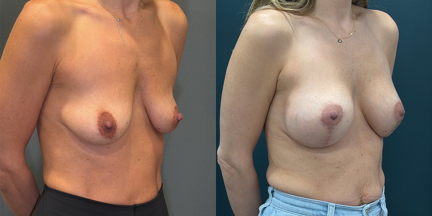Breast Augmentation Before & After