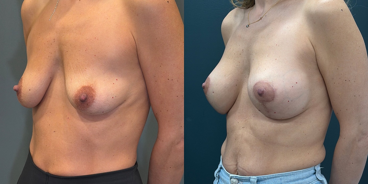 Breast Augmentation Before & After