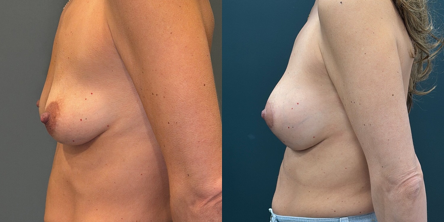 Breast Augmentation Before & After