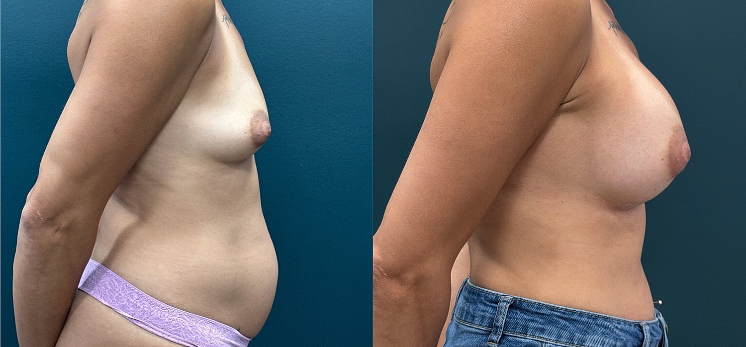 Breast Augmentation Before & After