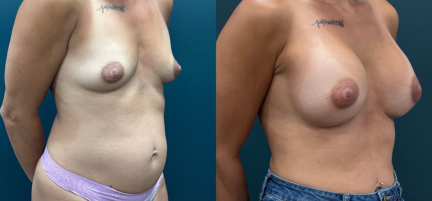 Breast Augmentation Before & After